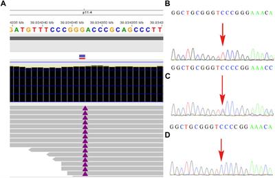 Case Report: Prenatal Diagnosis of a Novel Variant c.251dupT (p.N87Kfs*6) in BCOR Resulting in Oculofaciocardiodental Syndrome Using Whole-Exome Sequencing